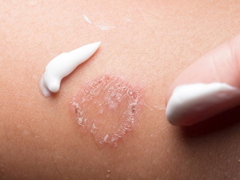 Cream-for-Ringworm