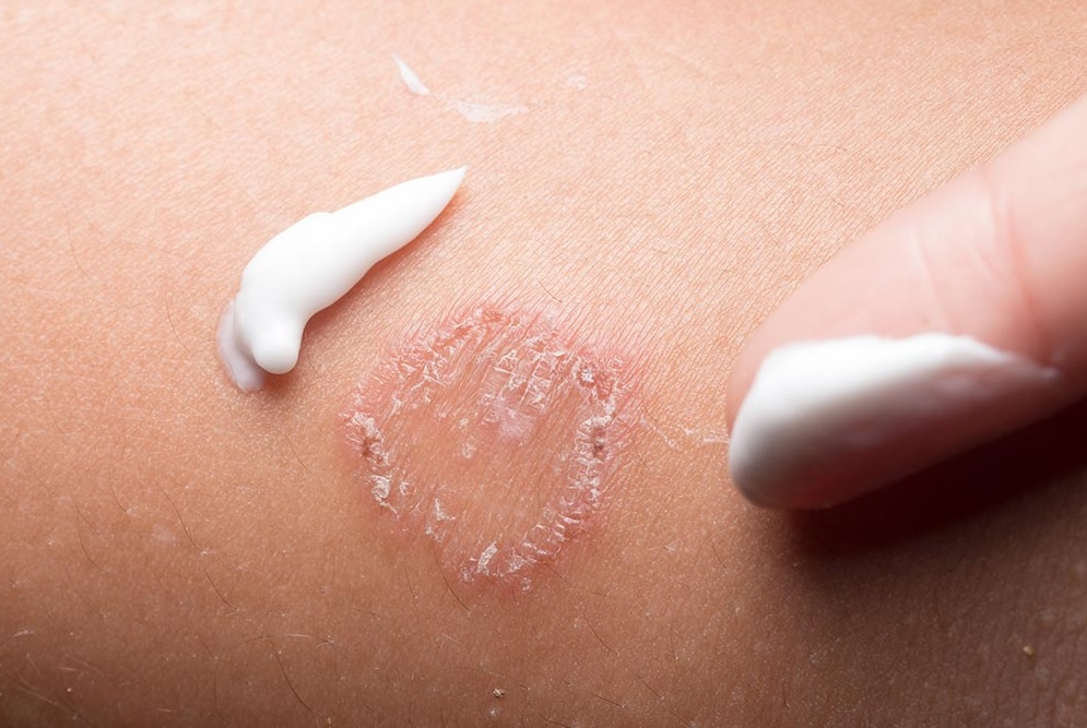 Cream for Ringworm